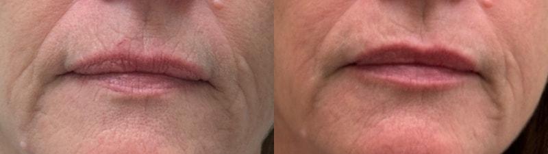SkinPerfected lip filler result — Woodridge, IL