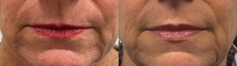 SkinPerfected lip filler result — Woodridge, IL