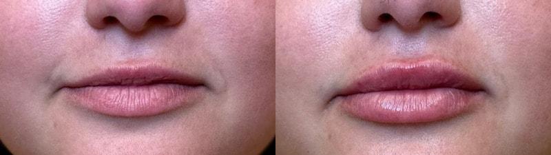 SkinPerfected lip filler result — Woodridge, IL