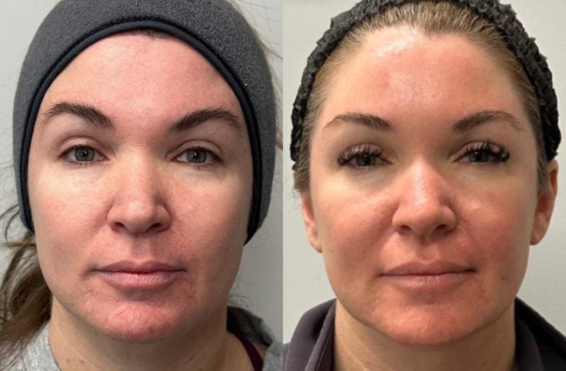 SkinPerfected microneedling result — Woodridge, IL