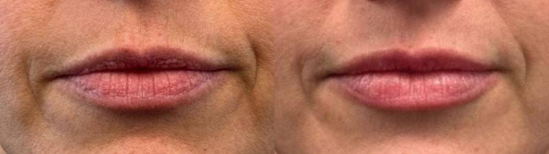 SkinPerfected lip filler result — Woodridge, IL