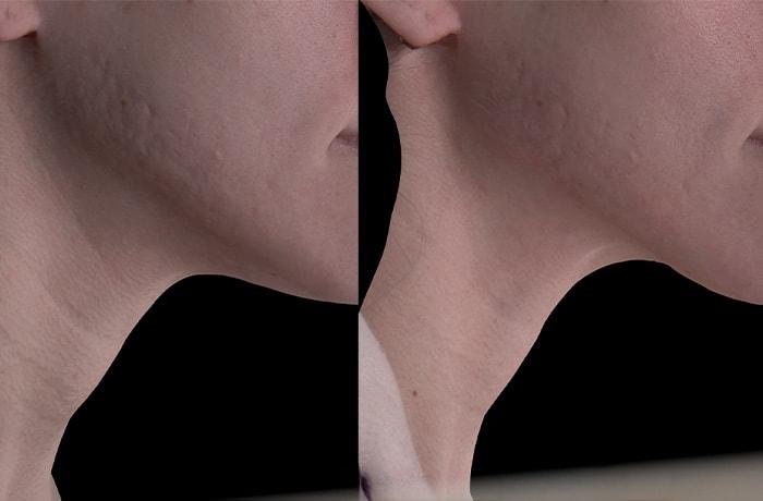 SkinPerfected microneedling result — Woodridge, IL