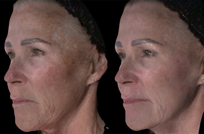 SkinPerfected photofacial result — Woodridge, IL