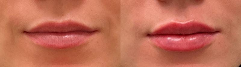 SkinPerfected lip filler result — Woodridge, IL