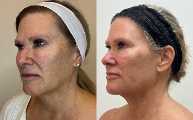 SkinPerfected photofacial result — Woodridge, IL