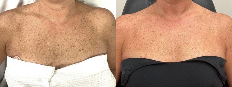 SkinPerfected photofacial result — Woodridge, IL