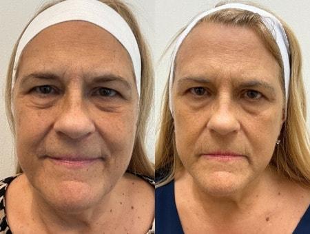 SkinPerfected photofacial result — Woodridge, IL