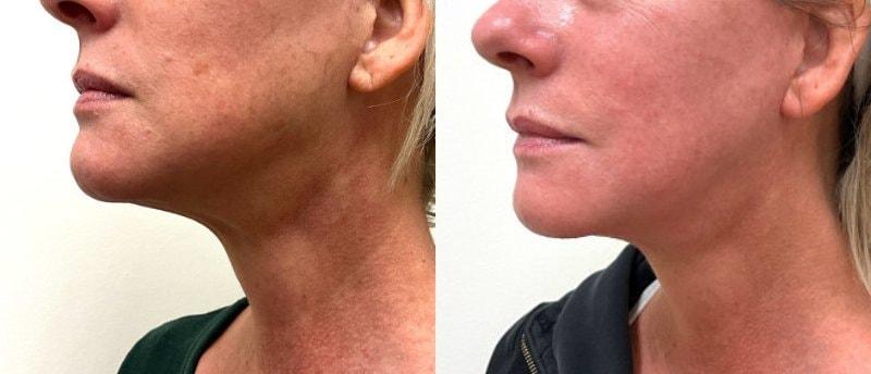 SkinPerfected microneedling result — Woodridge, IL