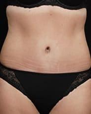 David A. Hidalgo, MD tummy tuck after — New York, NY