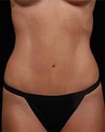 David A. Hidalgo, MD tummy tuck after — New York, NY
