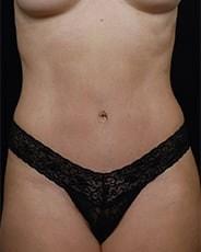David A. Hidalgo, MD tummy tuck after — New York, NY