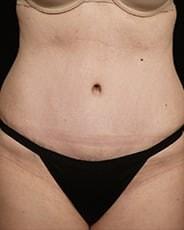 David A. Hidalgo, MD tummy tuck after — New York, NY