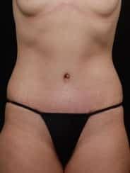 David A. Hidalgo, MD tummy tuck after — New York, NY