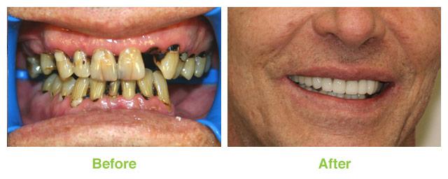 Salt Lake Dental Care veneers result — Murray, UT