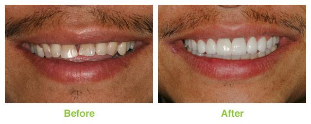 Salt Lake Dental Care veneers result — Murray, UT