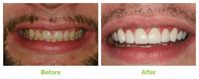 Dental Veneers result at Salt Lake Dental Care in Murray, UT
