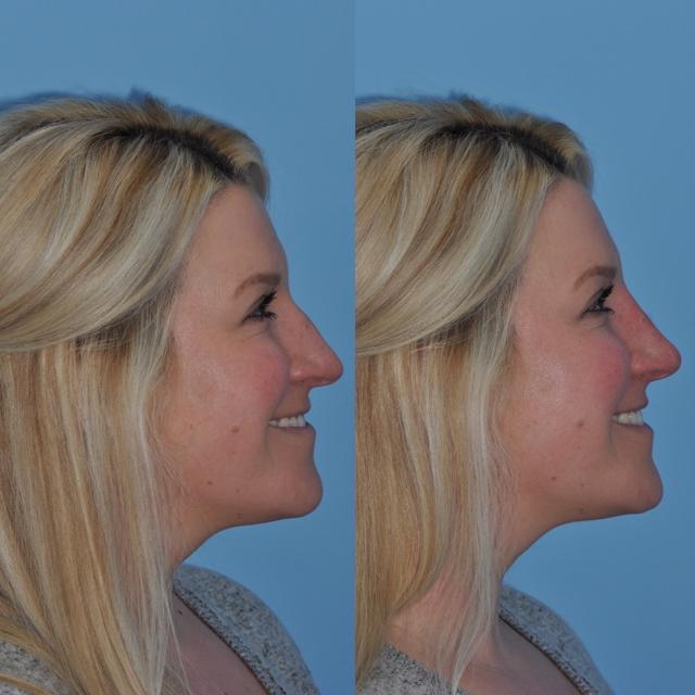 Liquid Rhinoplasty result at Bloom Facial Plastic & Aesthetic Surgery in Bryn Mawr, PA