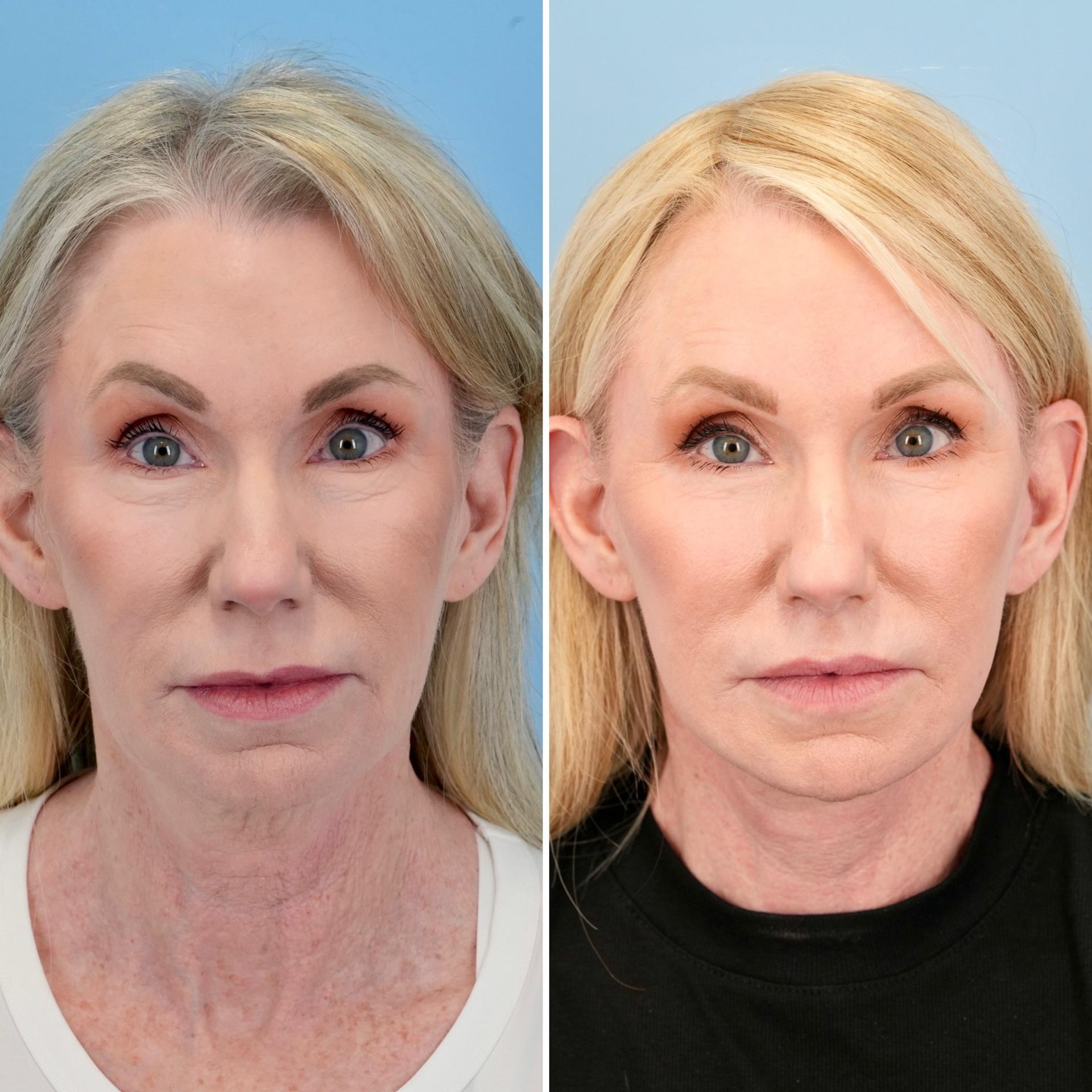 Bloom Facial Plastic & Aesthetic Surgery lip lift result — Bryn Mawr, PA