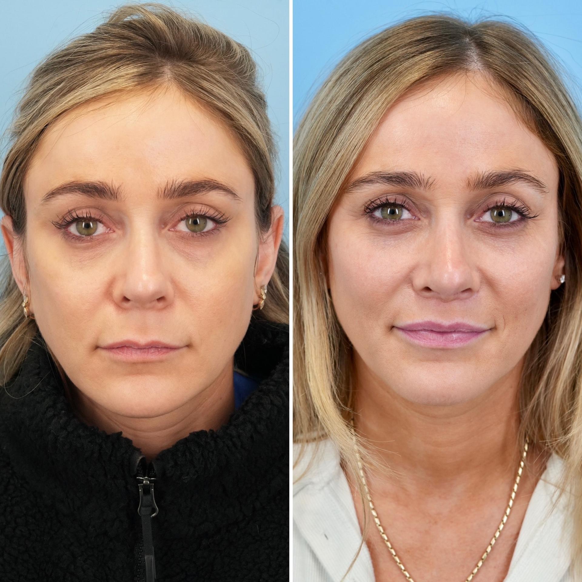 Bloom Facial Plastic & Aesthetic Surgery lip lift result — Bryn Mawr, PA