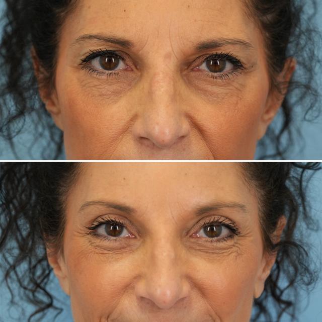 Blepharoplasty result at Bloom Facial Plastic & Aesthetic Surgery in Bryn Mawr, PA
