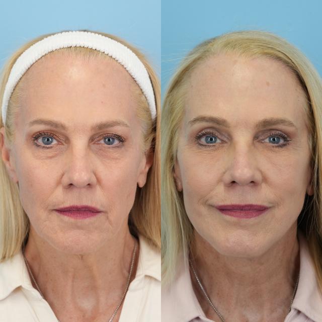 Deep Plane Facelift result at Bloom Facial Plastic & Aesthetic Surgery in Bryn Mawr, PA