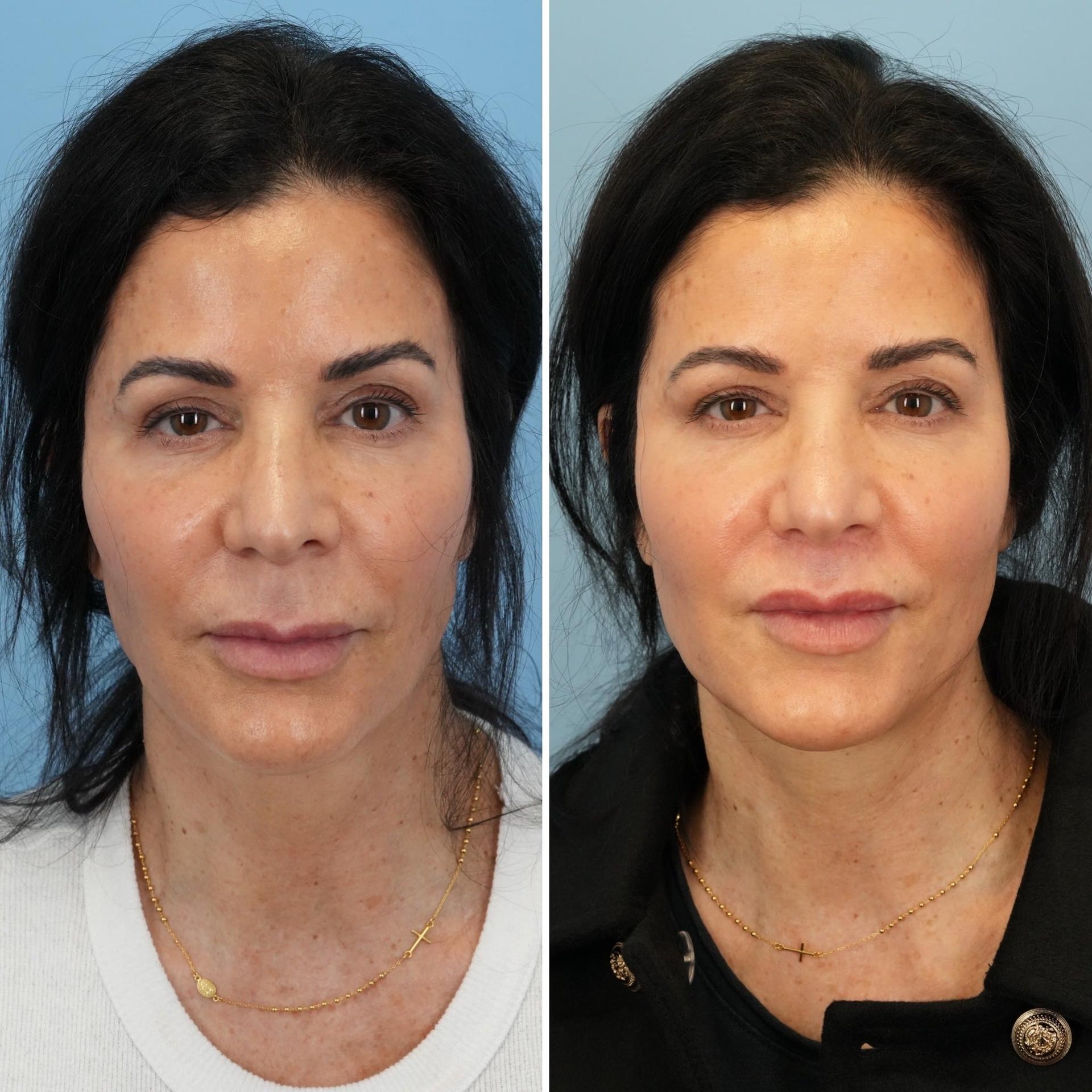 Bloom Facial Plastic & Aesthetic Surgery lip lift result — Bryn Mawr, PA