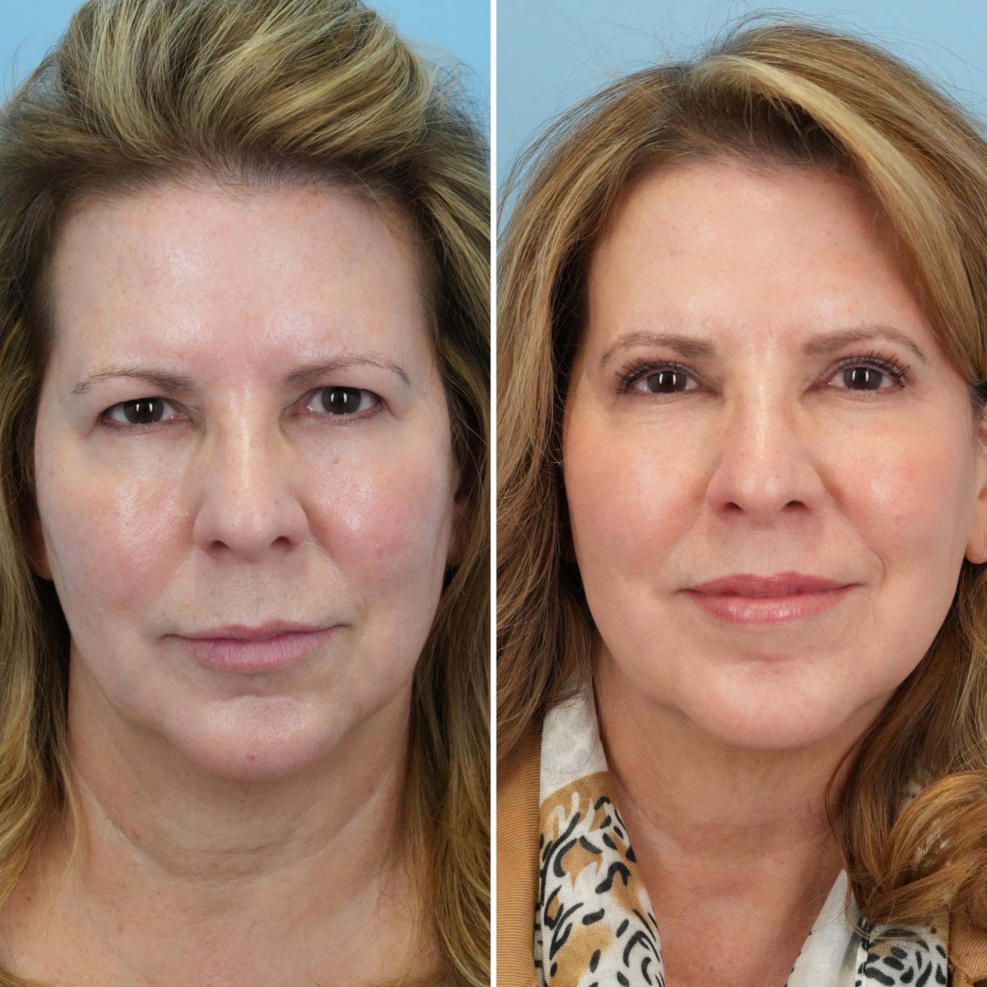 Bloom Facial Plastic & Aesthetic Surgery lip lift result — Bryn Mawr, PA
