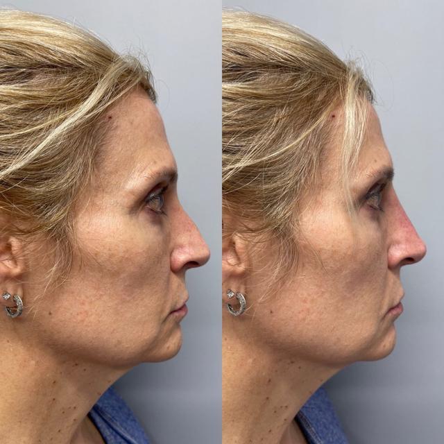 Liquid Rhinoplasty result at Bloom Facial Plastic & Aesthetic Surgery in Bryn Mawr, PA
