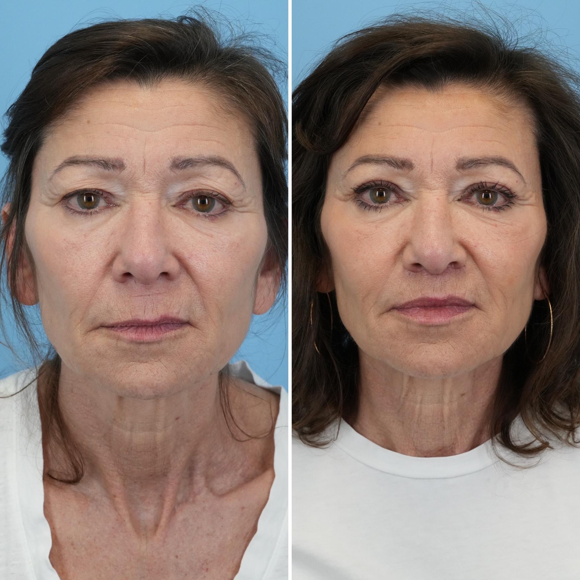 Bloom Facial Plastic & Aesthetic Surgery lip lift result — Bryn Mawr, PA