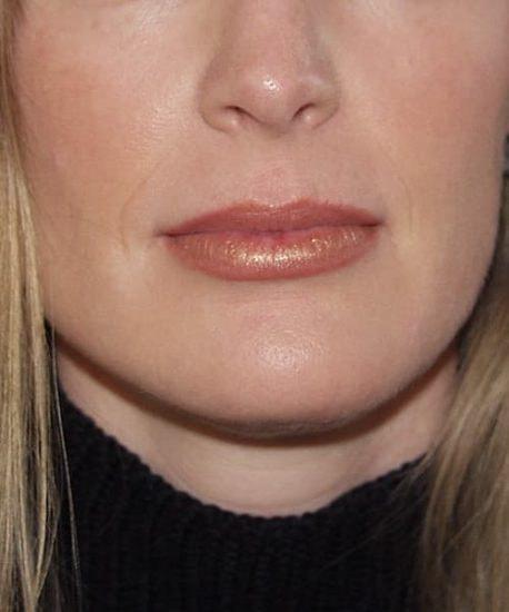John M. Hilinski, MD neck liposuction after — Coronado, CA