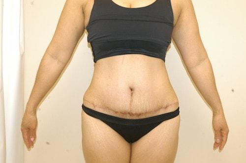 James Black, MD tummy tuck after — Torrance, CA