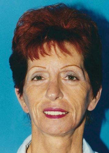 James Black, MD facelift after — Torrance, CA
