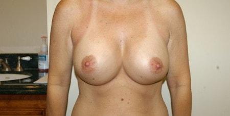 James Black, MD breast augmentation after — Torrance, CA