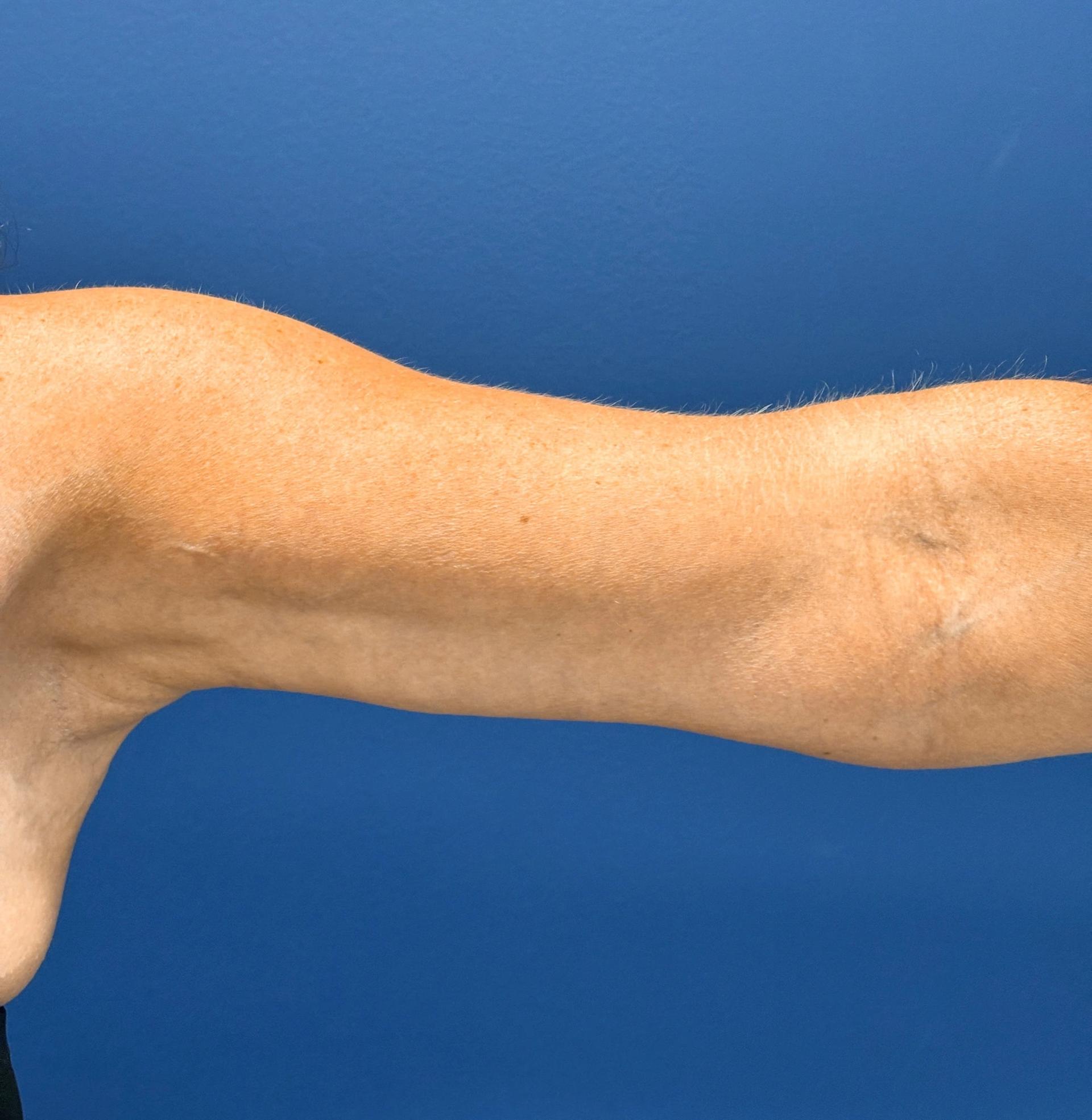 Frank P. Albino, MD arm lift after — Tysons, VA