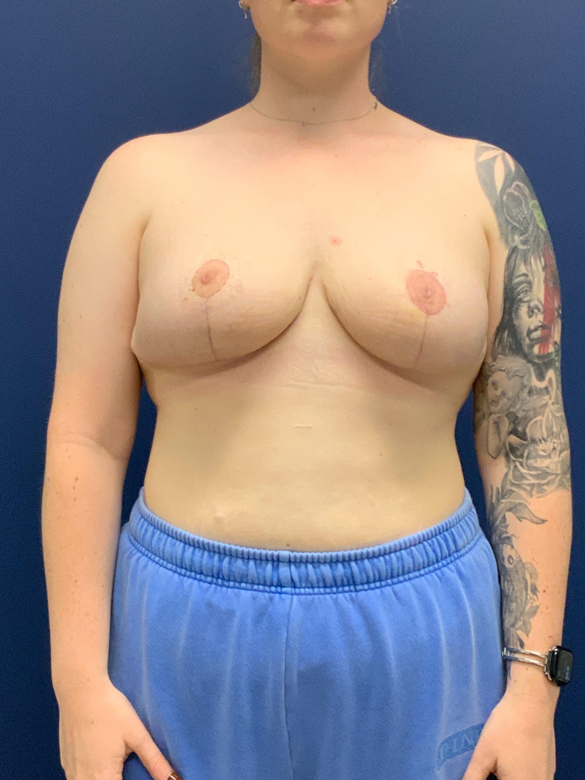 Frank P. Albino, MD breast reduction after — Tysons, VA