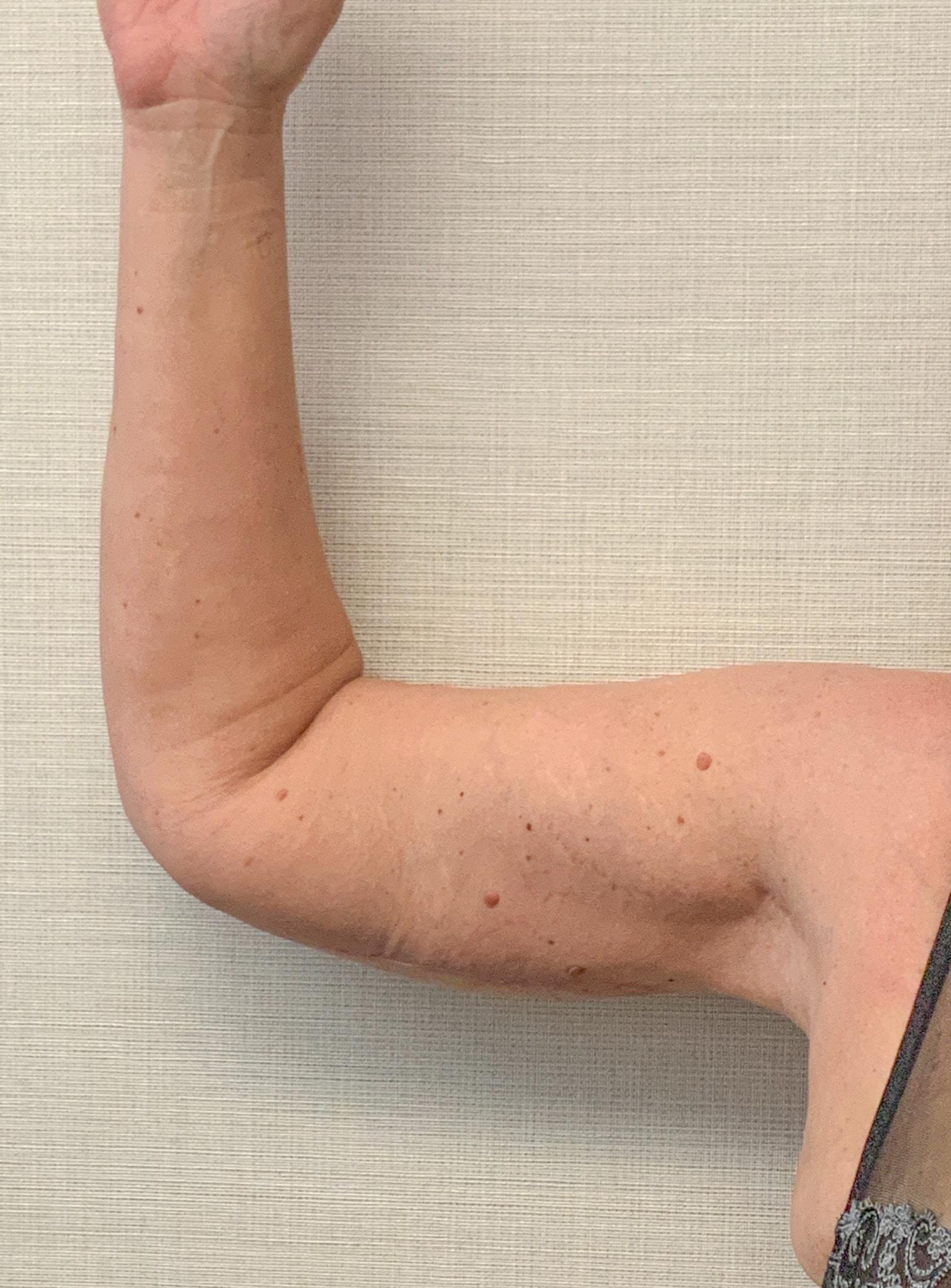 Frank P. Albino, MD arm lift after — Tysons, VA