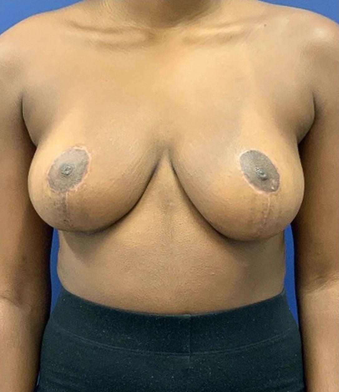 Frank P. Albino, MD breast reduction after — Tysons, VA