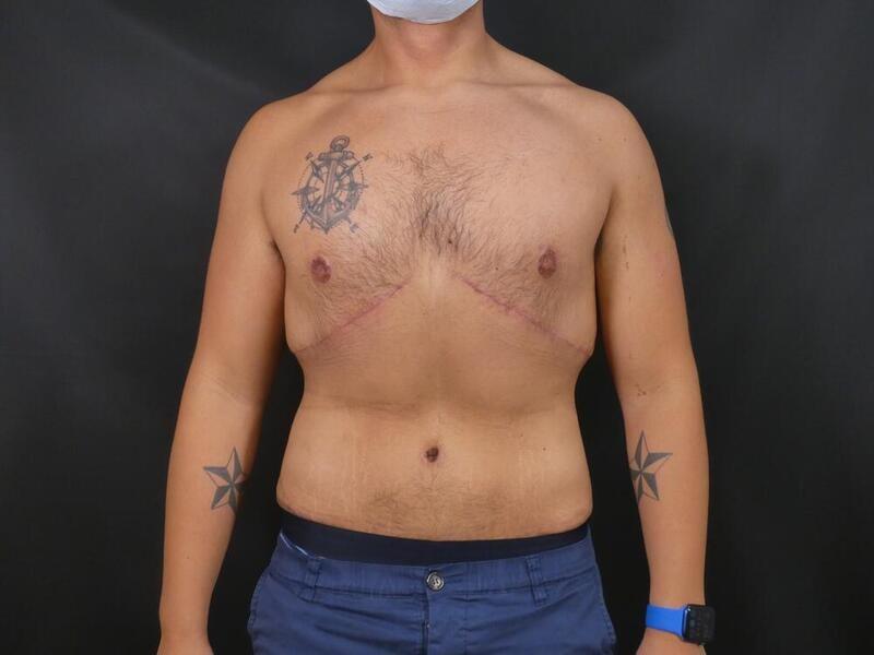 Michael Horn Plastic Surgery & Med Spa gynecomastia after — Chicago, IL