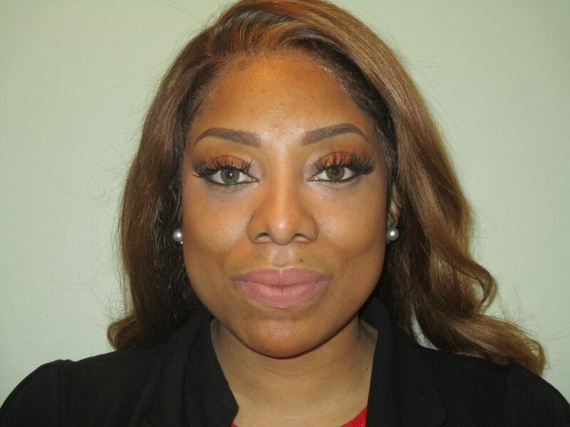 Michael Horn Plastic Surgery & Med Spa buccal fat removal after — Chicago, IL