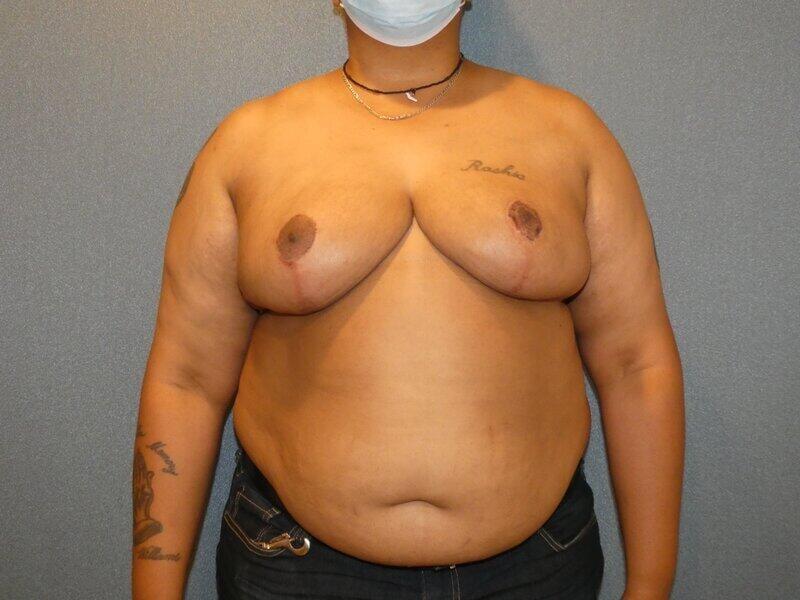 Michael Horn Plastic Surgery & Med Spa breast reduction after — Chicago, IL