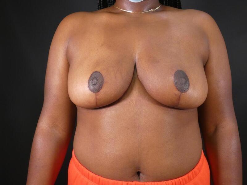 Michael Horn Plastic Surgery & Med Spa breast reduction after — Chicago, IL