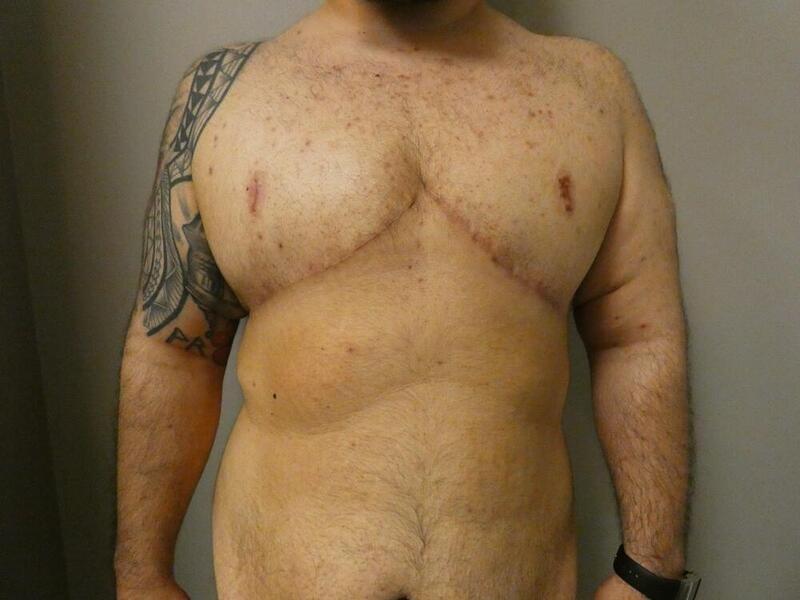 Michael Horn Plastic Surgery & Med Spa gynecomastia after — Chicago, IL