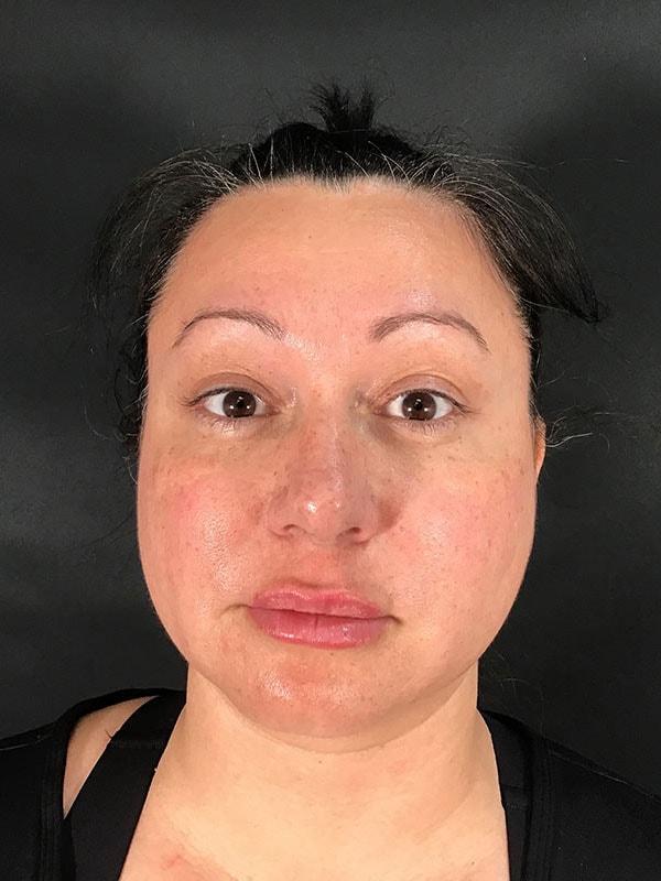 Neck Liposuction before at Michael Horn Plastic Surgery & Med Spa in Chicago, IL