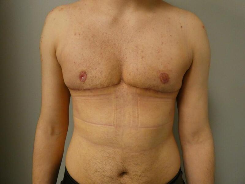 Michael Horn Plastic Surgery & Med Spa gender affirming top surgery after — Chicago, IL
