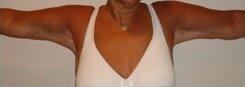 Arm Lift after at Michael Horn Plastic Surgery & Med Spa in Chicago, IL