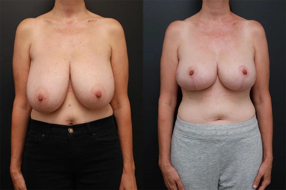 Motakef Plastic Surgery + Med Spa breast reduction result — Yorba Linda, CA