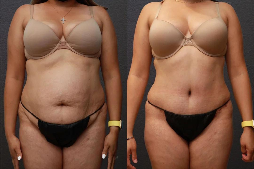 Motakef Plastic Surgery + Med Spa tummy tuck result — Yorba Linda, CA