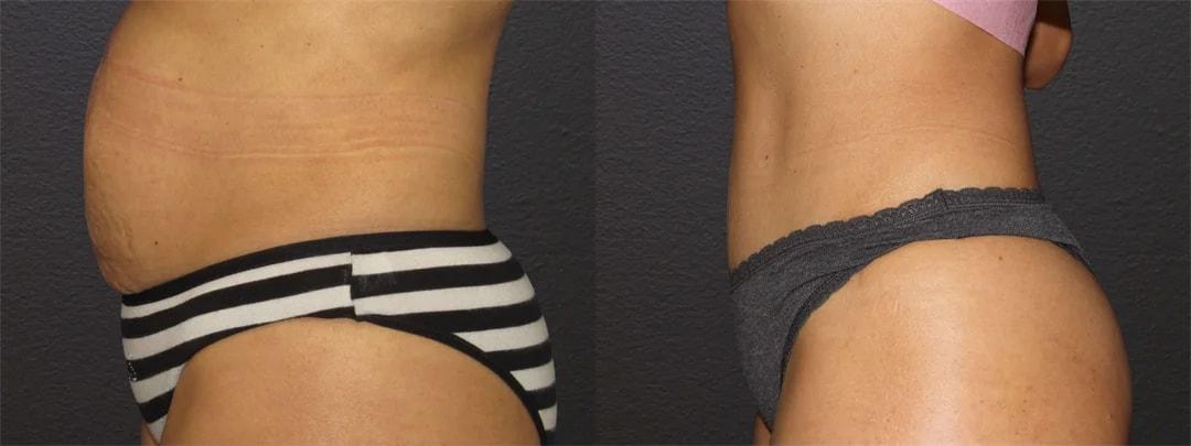 Motakef Plastic Surgery + Med Spa tummy tuck result — Yorba Linda, CA