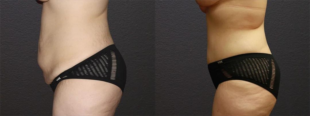Motakef Plastic Surgery + Med Spa tummy tuck result — Yorba Linda, CA