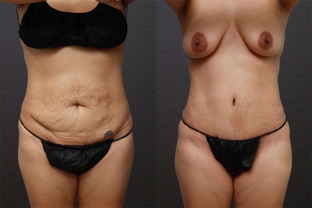 Motakef Plastic Surgery + Med Spa mommy makeover result — Yorba Linda, CA